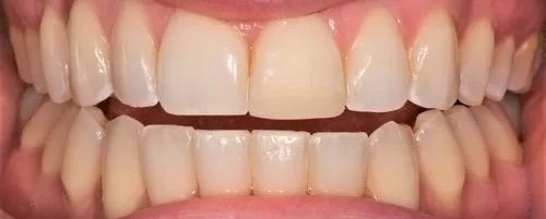 Bonding and Fillings 1 after