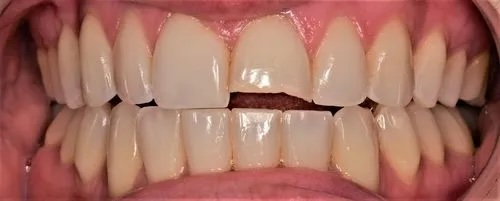 Bonding and Fillings 1 before