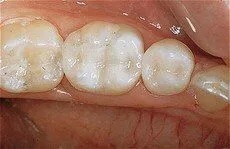 Bonding and Fillings 2 after