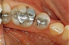 Bonding and Fillings 2 before