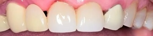 Crowns 1 after