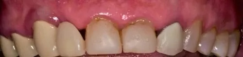 Crowns 1 before