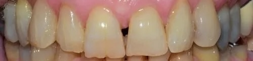 Crowns 2 before