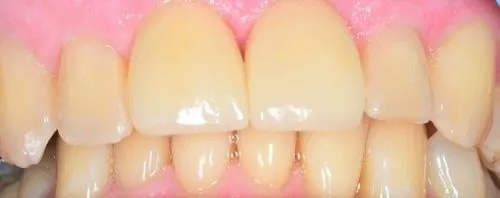 Crowns 3 after