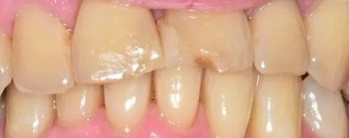 Crowns 3 before