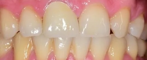 Crowns 4 after