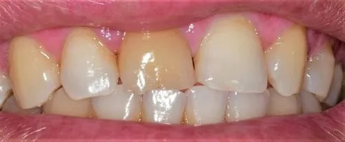 Crowns 4 before
