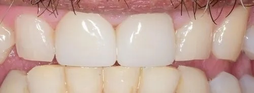 Crowns 5 after