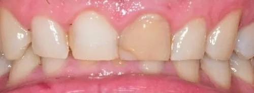 Crowns 5 before