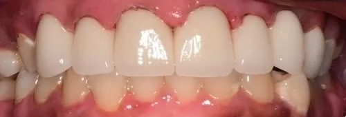 Crowns 6 after