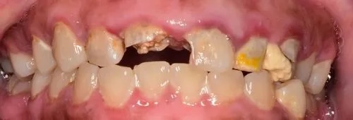 Crowns 6 before