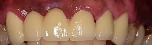 Crowns 7 after
