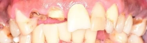 Crowns 7 before