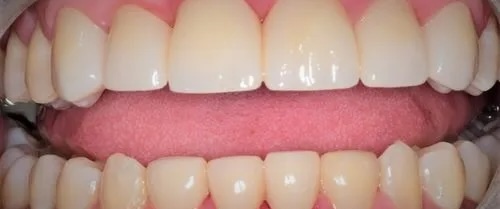 Crowns 8 after