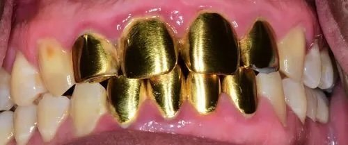 Crowns 8 before