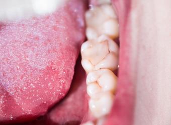 3 Signs that Your Dental Filling Is Going Bad